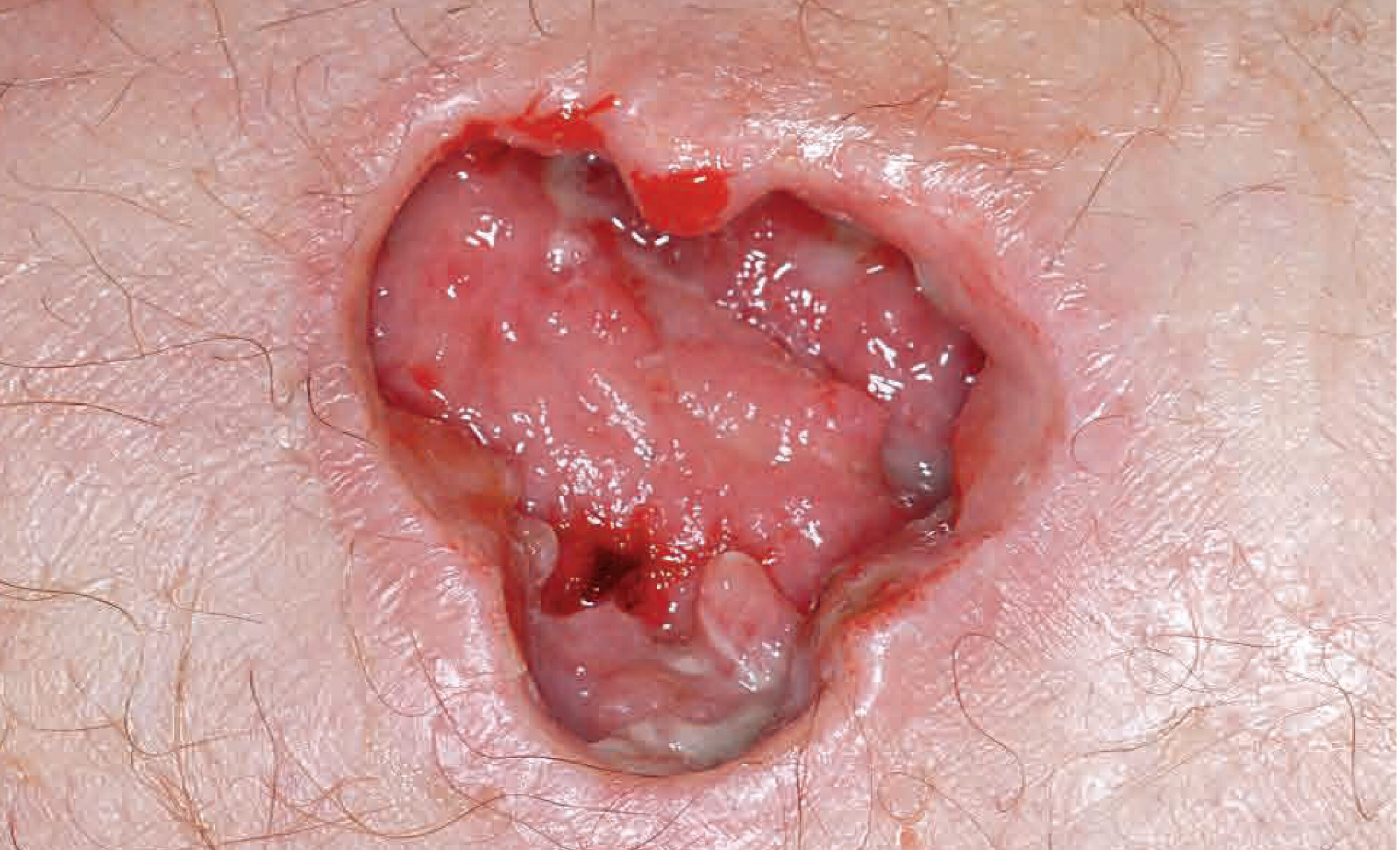 1101STAPH_lo-1